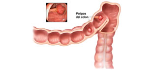 Cáncer de colon y cáncer de recto